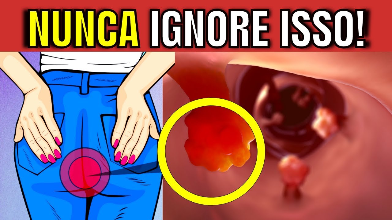 7 BOWEL CANCER ALERT SYMPTOMS: SILENT SIGNS YOU CANNOT IGNORE!