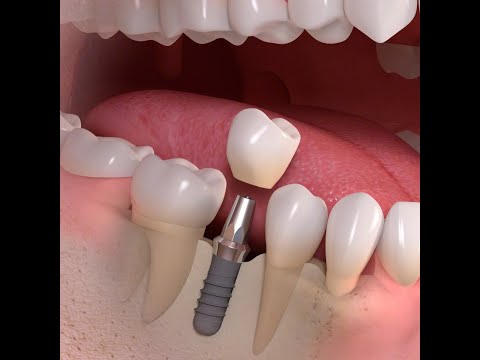 Implantologia  Trattamento singolo dente su impianto