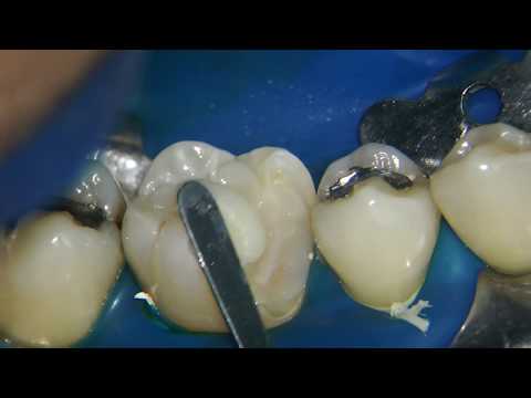 Second part of: indirect composite restoration. The cementation.