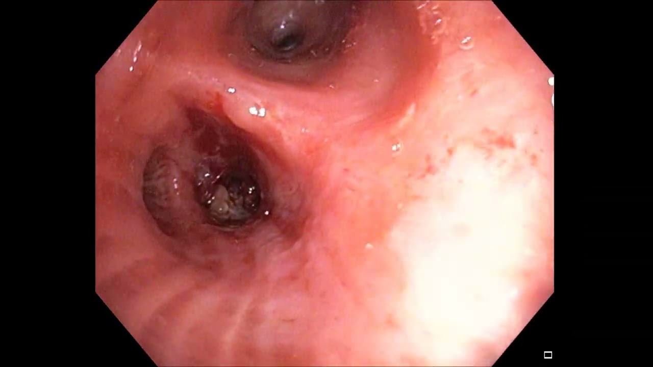 Tratamiento broncoscópico de hamartoma endobronquial