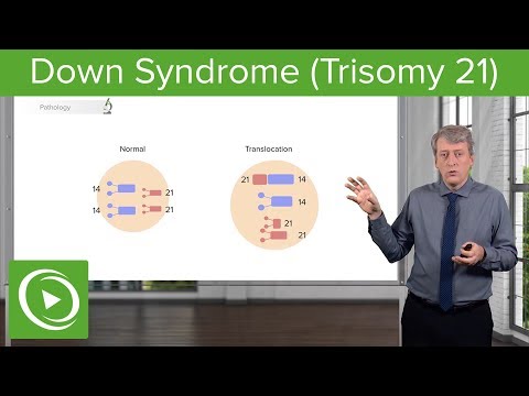 Trisomy 21: Etiology, Pathology, Diagnosis & Management – Pediatrics | Lecturio