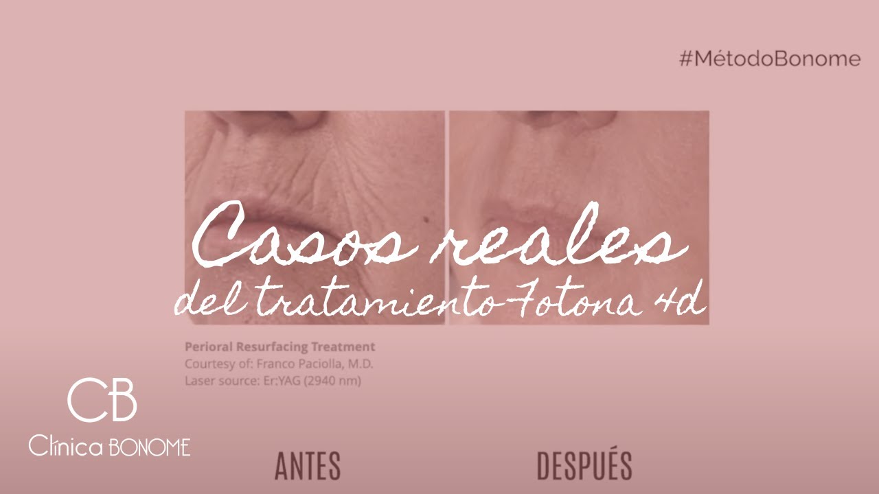 FOTONA 4D-5D x CLÍNICA BONOME | Casos reales del antes y después del tratamiento
