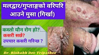 Download lagu Genital warts in Nepali | गुप्ताङ्गमा / यौनाङ्गमा आउने मुसा | यौन रोग [ Complete Information] mp3