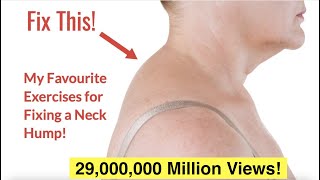 Download lagu How to Fix a Neck Hump at Home With FREE Exercise ... mp3