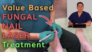 Value Based Fungal Nail Laser Treatment by Dr. Michael Horwitz
