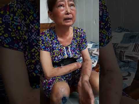 Hoại Tử Do Tiểu Đường, nằm lâu ngày