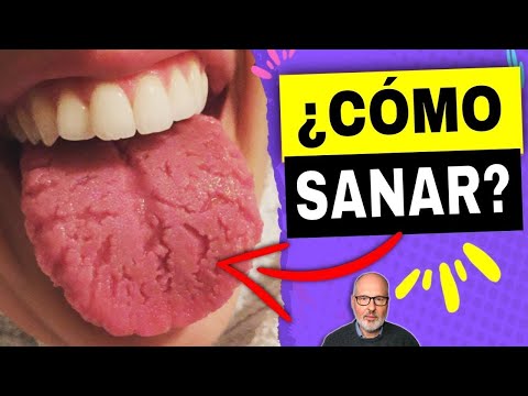 HOW TO HEAL CRACKED TONGUE (NATURAL REMEDIES)
