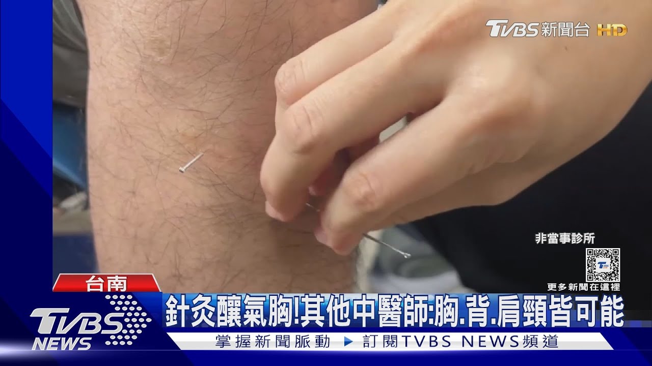 患者控針灸害氣胸! 其他中醫師:氣胸多半針灸當日發生