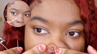 How to pop and Get rid of nose piercing bump (keloid) FAST