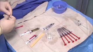 Uterine Artery Embolization UFE Fibroids