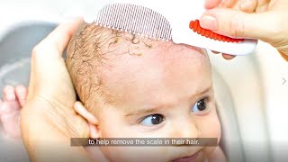 Newswise:Video Embedded 4-cradle-cap-tips-from-dermatologists