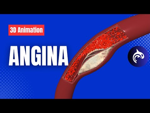 Angina (3D Animation) - Understand Chest Pain from Reduced Blood Flow to the Heart