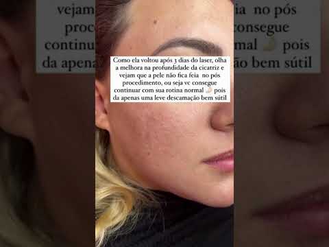 Laser CO2 Fracionado (Tratamento Eficaz para Cicatriz de Acne) - Maria Menina Clínica de Estética