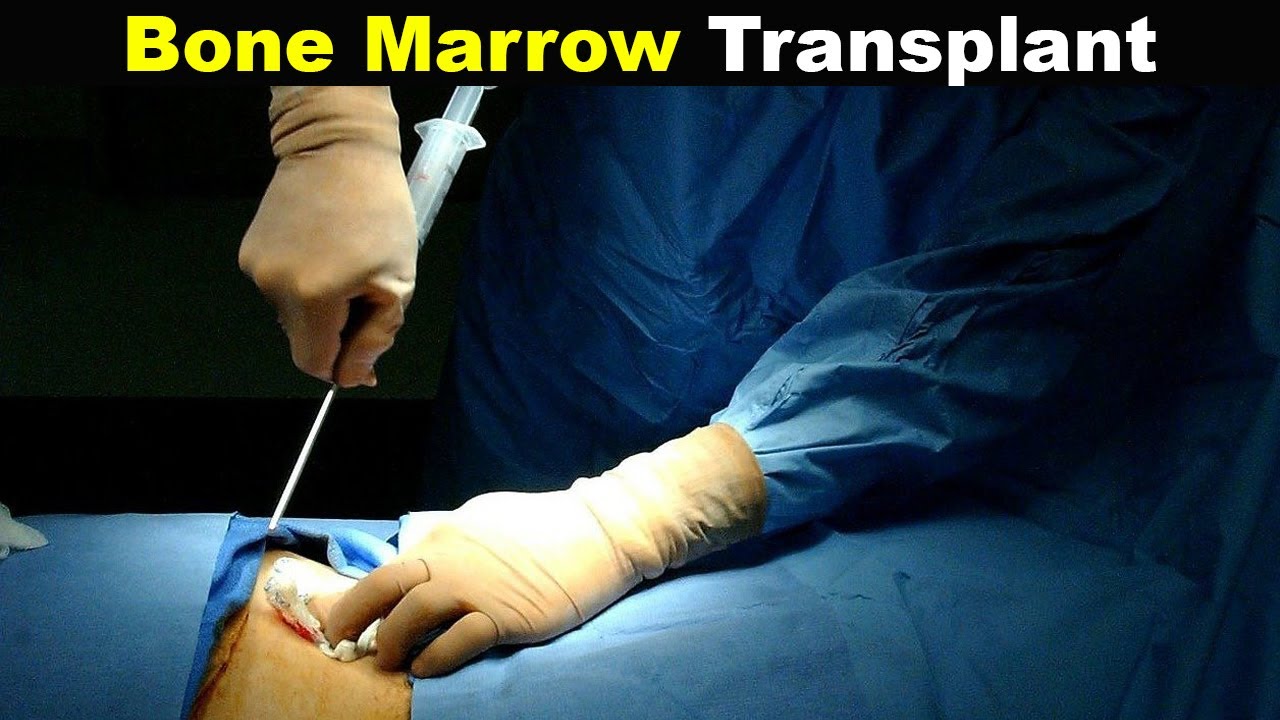 How Does Bone Marrow Transplant Works (Urdu/Hindi)