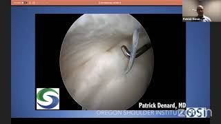 Remplissage and Labral Repair