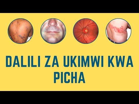 🚨ATTENTION!!🚨 Zifahamu Dalili za UKIMWI kwa kuangalia picha