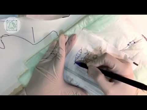Medical talks : Suture( inverted simple - subcuticular -figure of 8 ) techniques