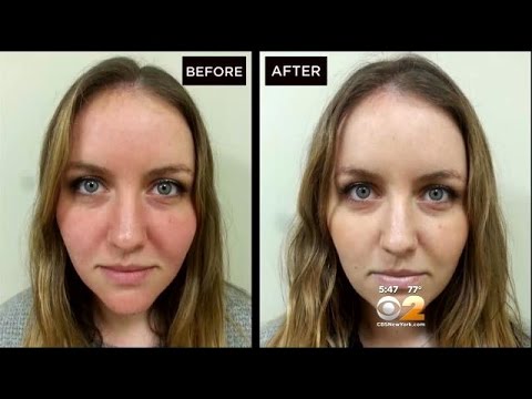 Dr. Max Gomez: Rosacea Treatment