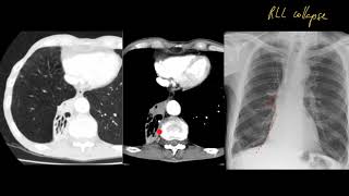 That chest x-ray looks normal, why is it in my exam How to approach the unremarkable one