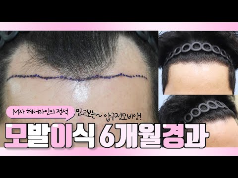 30대 중반 남성, M자 모발이식,절개, 3600모 6개월 경과영상!