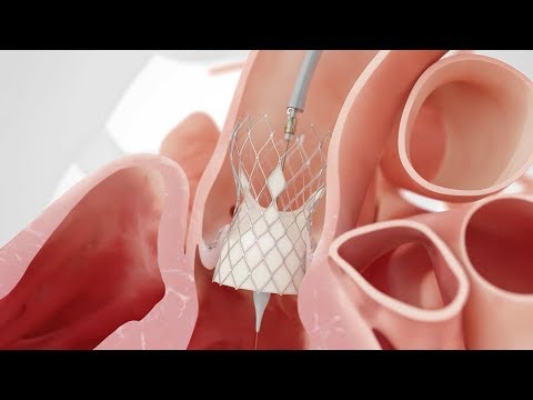 TAVI bei Aortenstenose | Medizinische Animation