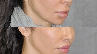 Best Upper Lip Lift Surgeon & Revision Specialist Describes Modified Upper Lip lift in Beverly Hills