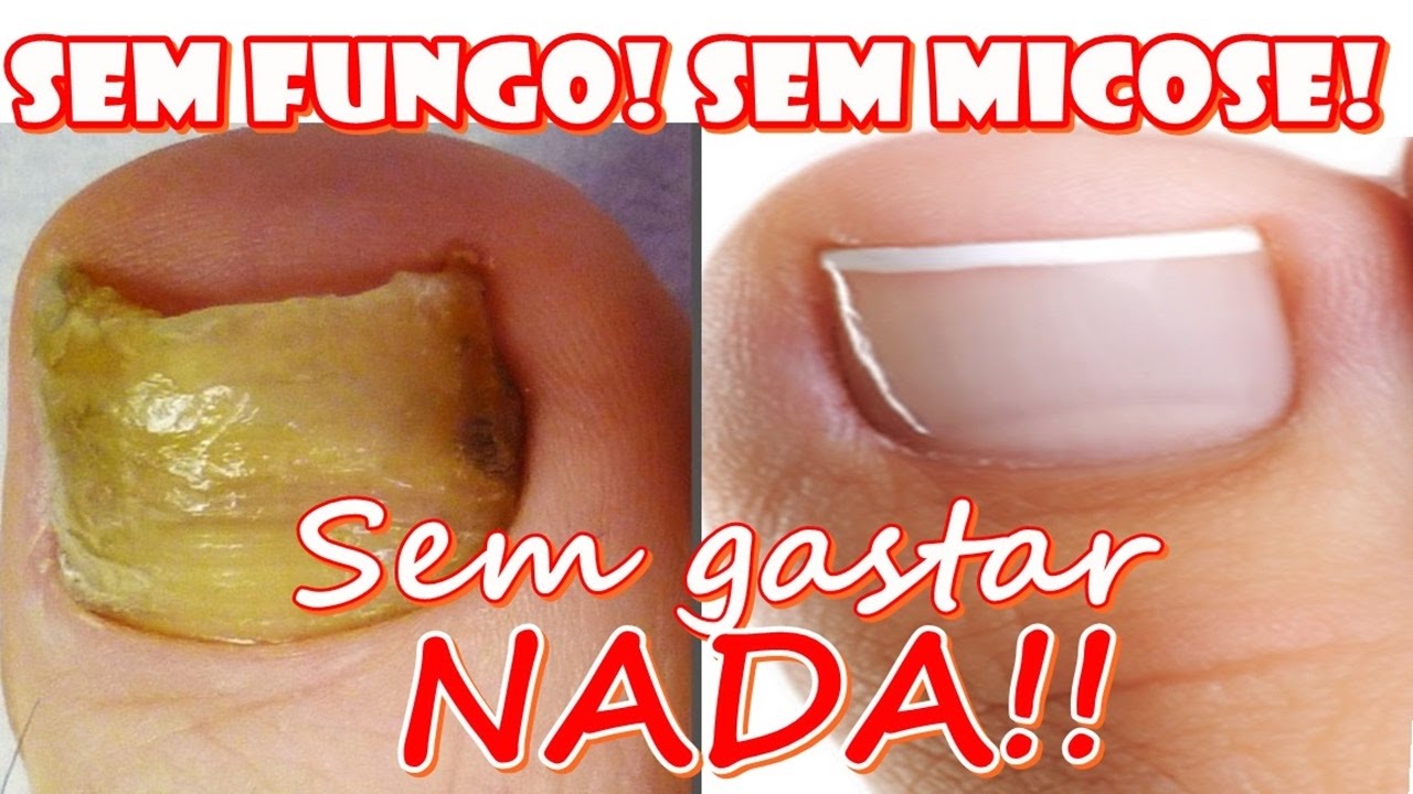 PODEROSO REMÉDIO CASEIRO PARA MATAR FUNGOS NA UNHA (sem gastar um centavo)  Fran Adorno