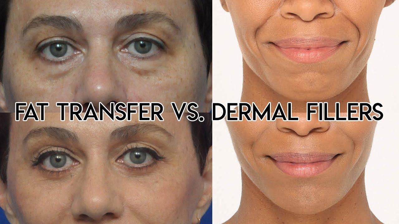 Fat Transfer vs Dermal Filler