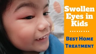 Swollen Eyes in Kids + Best Treatment
