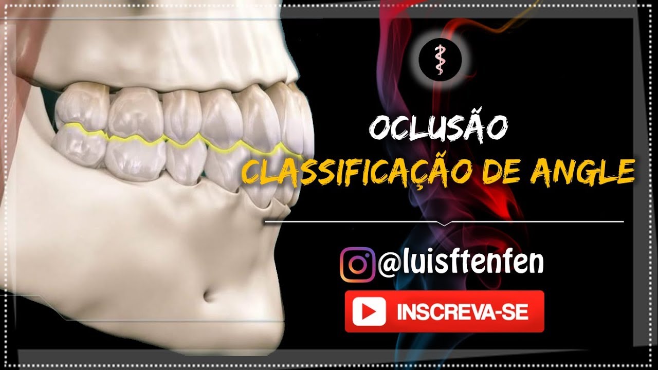 Classificação de Angle - Classe I, II e III