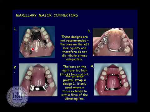 Classification and Components of Removable Partial Dentures