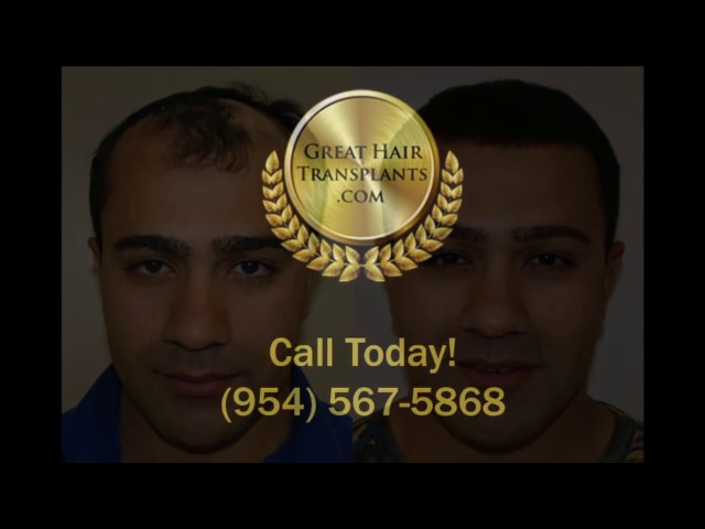 
Dr. Brett Bolton Patient Amir MaxHarvest&trade; Plus Hair Transplant
