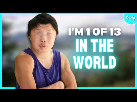 My Rare Condition Makes My Face Look Like A Mask | BORN DIFFERENT