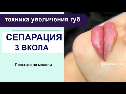 Сепарация губ / 3 вкола - техника увеличения губ