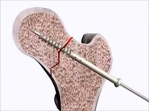 Tecnica ad ultrasuoni del rachide cervicale nei bambini Cuscini ortopedici con danni osteocondrosi cervicale