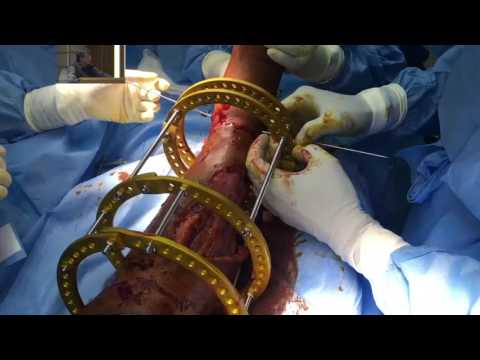 Grade 3C Tibial Fracture With Circumferential Skin Loss, Managed Without Plastic Procedures By Ilizarov