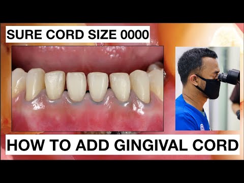 How to placement Gingival Cord for Veneers Preparation