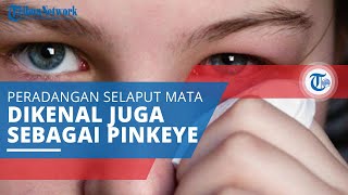 Konjungtivitis, Peradangan Selaput Bening yang Menutupi Bagian Putih Mata (Sklera)