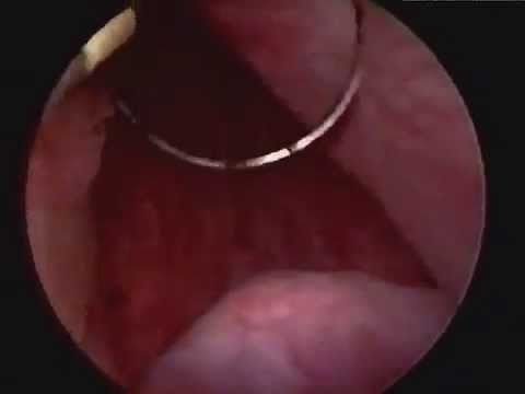 Prostata-Adenom Kaffee Menschliche Prostata-Organe Struktur