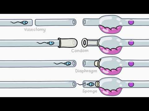 節育器是如何工作的？ (How Does Birth Control Work?)