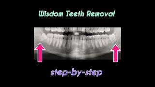 Wisdom Teeth Removal Video