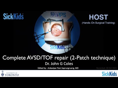 Complete AVSD/TOF repair (2-Patch technique)-Dr.John Coles-Full VDO