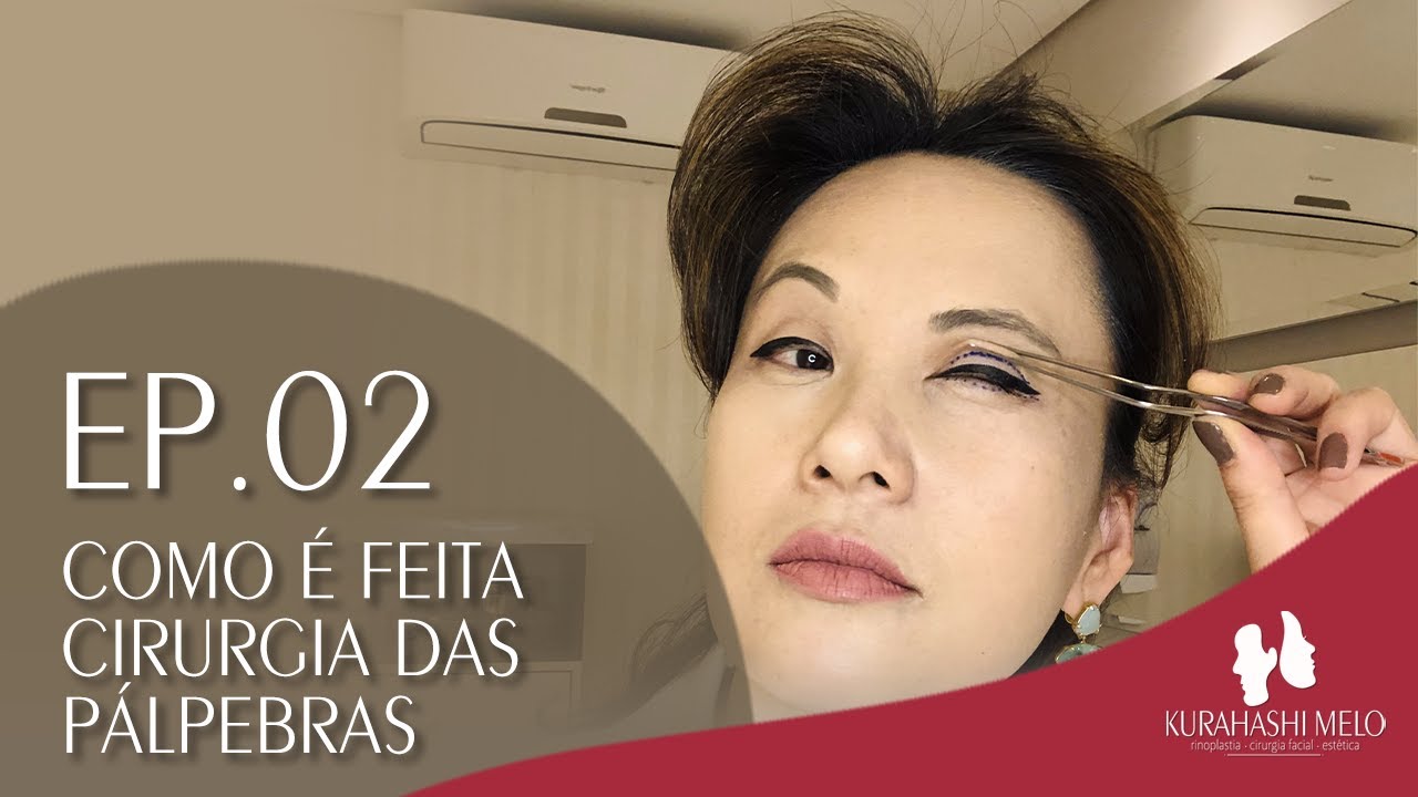 Blefaroplastia: Técnica Cirúrgica - Como é feita a Blefaroplastia | Ep 02 Dra.Andreia Kurahashi Melo