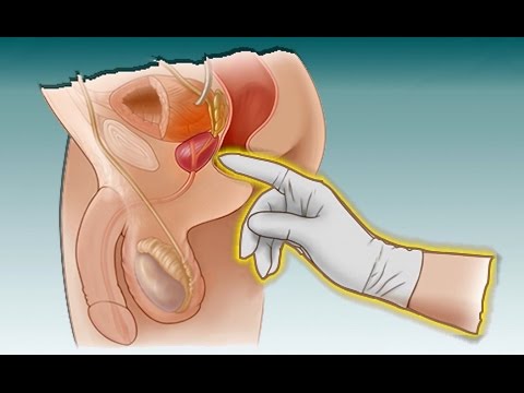 Hpv and neck lumps