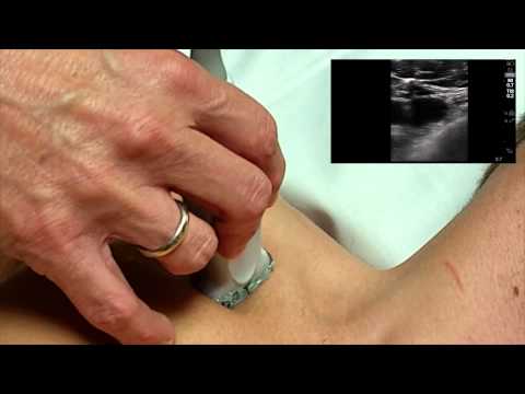 Ultrasound Guided Subclavian Line