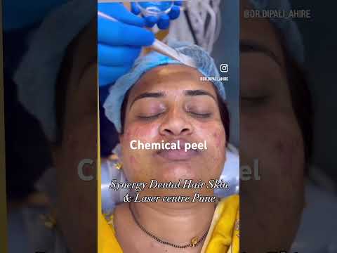Chemical Peel | Dr. Dipali Dambal