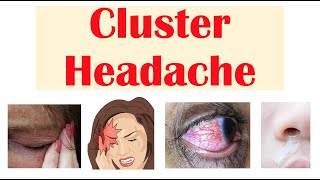 Cluster Headaches | Risk Factors, Triggers, Signs & Symptoms, Diagnosis, Treatment