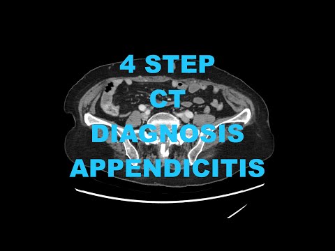 How to diagnose Acute Appendicitis on CT in 4 Steps - Radiology Medical Imaging Pearls, Tips, Tricks
