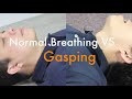 Sudden Cardiac Arrest (SCA) and Agonal Breathing (Gasping)