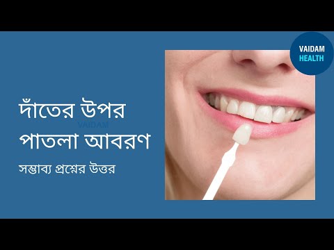 ডেন্টাল ভেনার্স- প্রায়শই জিজ্ঞাসিত প্রশ্ন